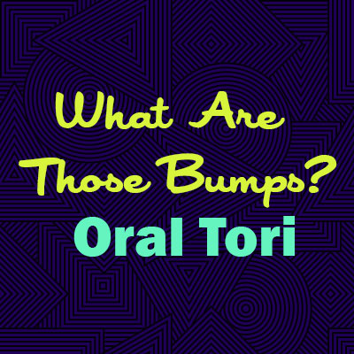 Rochester dentist, Dr. Kenneth Nozik & Dr. John Tumminelli at White Spruce Dental explains oral tori—what they are, why they happen, and whether they are a cause for concern.